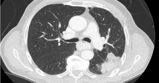 lung/retroperitoneal mass, with resolution of pain and