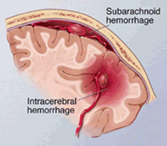 Pathology: Subarachnoid