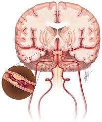 Pathology: Stroke A sudden appearance of neurological