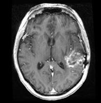 GLIOBLASTOMA MULTIFORME: NANOPLAN 5 MRI of glioblastoma
