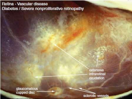 Studies by Hayreh have shown a close association between glaucomatous optic neuropathy and systemic vascular disorders such as diabetes.