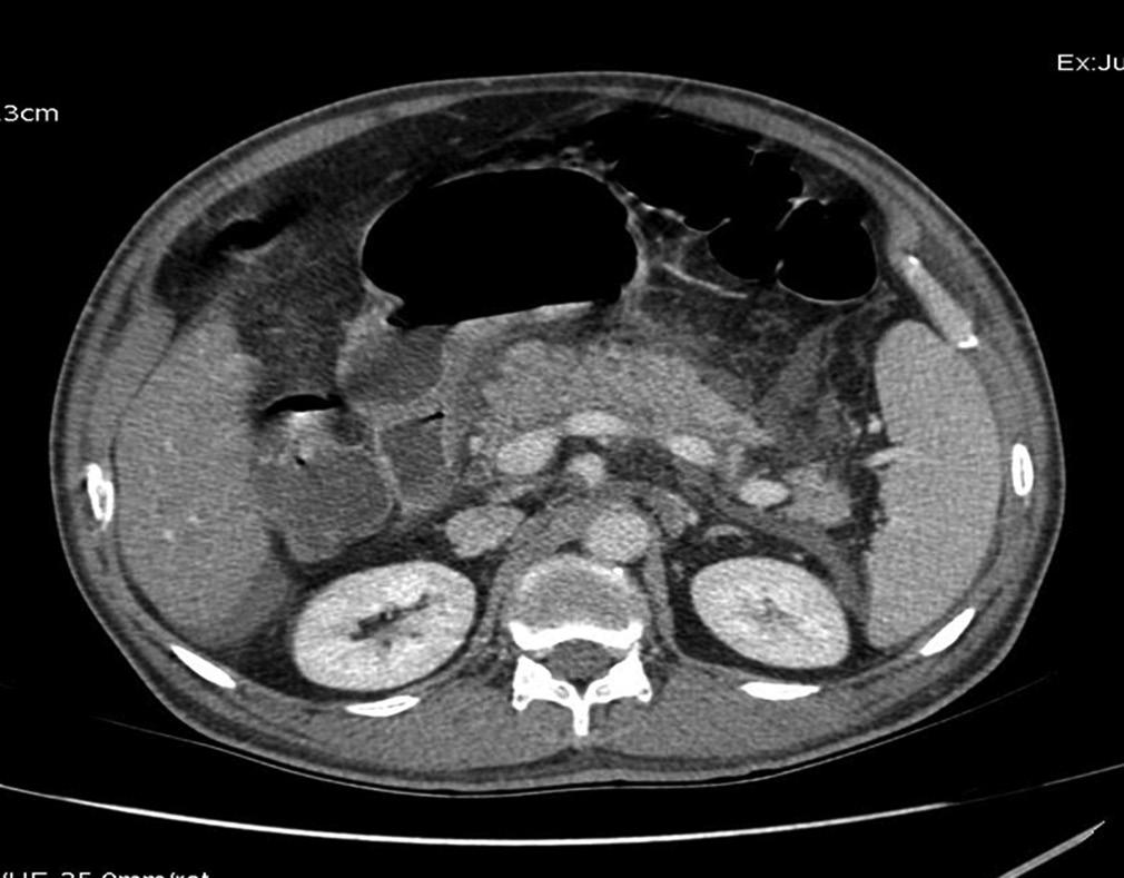 Figure 1: Bulky pancreas with peripancreatic fluid, fat stranding, and fluid in Morrison s pouch