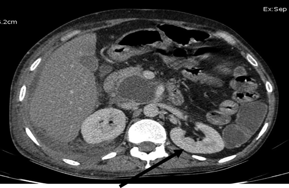 gallstones Extrapancreatic complications (one or more of pleural effusion, ascitis, vascular
