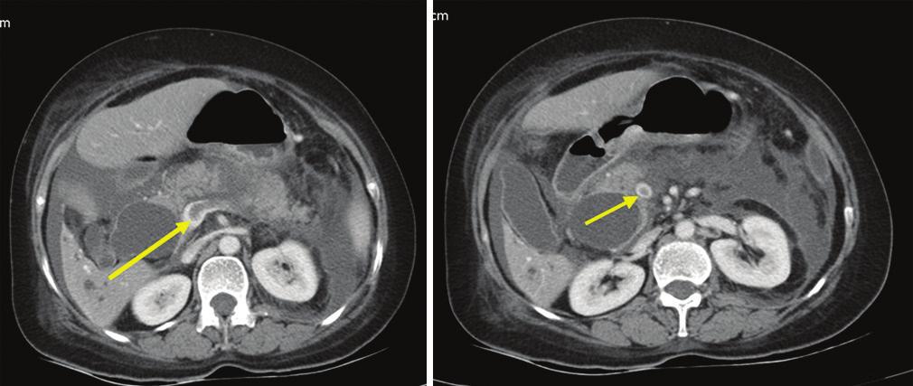 There is filling defect in the left branch of the portal vein (yellow arrow) and right perinephric fat stranding Figure 14: Non-enhanced computed