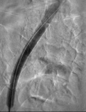 Final Result Treatment with AngioJet Solent Omni Thrombectomy catheter.