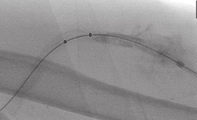 future thrombotic events. Pre-procedure AngioJet catheter positioned in thrombosed AV graft.