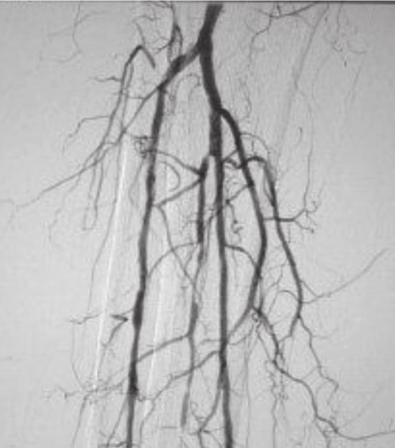 both venous and arterial side of AV graft Pharmacomechanical thrombecomty with AngioJet Solent Dista AngioJet Solent Dista Catheter