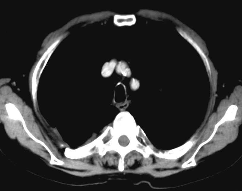 NSCLC: partial response CT at 3