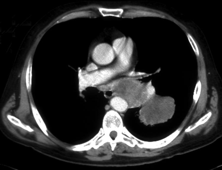 NSCLC: non-responder CT at three