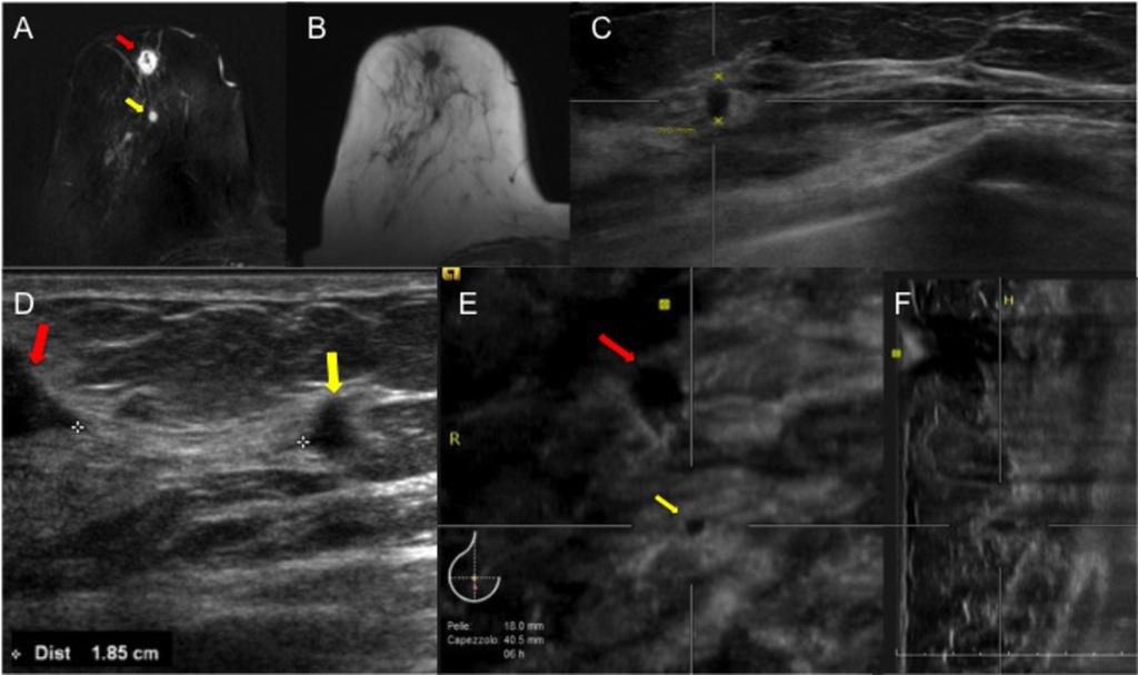 Images for this section: Fig. 1: Sixty-two years old woman with biopsy-diagnosed invasive ductal carcinoma of the right breast.