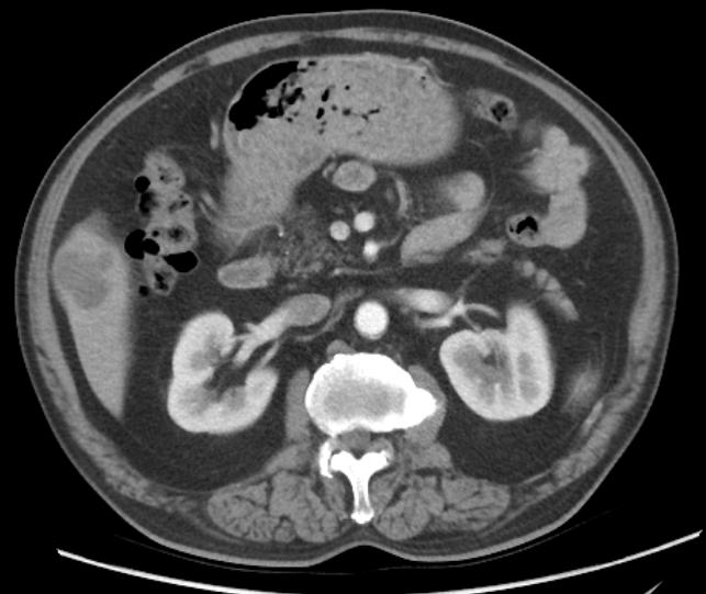 Patient profile (#2009): After 2 weeks' treatment, target lesion (liver