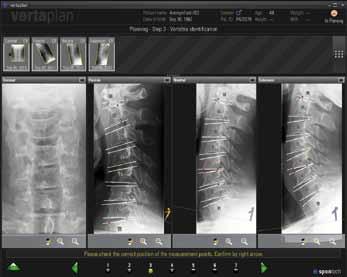 Fast, reliable implant planning for optimum patient treatment Supports additional sections of the spine For the first time ever supports not only measurements and planning in the lumbar region, but