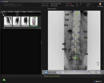 Whether you want to measure the pelvic angle in the coronal plane or you need to monitor the progress of scoliosis in the thoracic region - provides the tools you need.