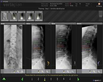 Intelligent combination of software and appropriate implants for optimum surgical outcomes For preoperative planning you need four functional X-rays in DICOM