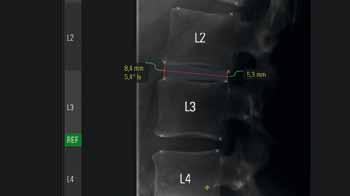 In the functional X-rays, all of the vertebra are first of all labeled. The measuring points are placed automatically and can be corrected by the surgeon.