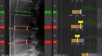 Implant planning in the cervical spine region Vertebral marking in the lumbar spine region Takes the motion parameters of the individual patient into account