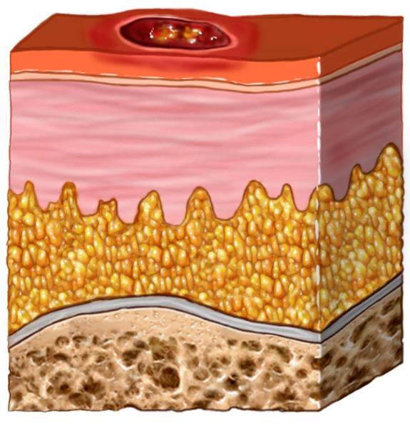 Pressure injury - Stage 1 4 Intact skin with non-blanchable redness A change in the skin temperature (warm or coolness) Tissue consistency has a firm or