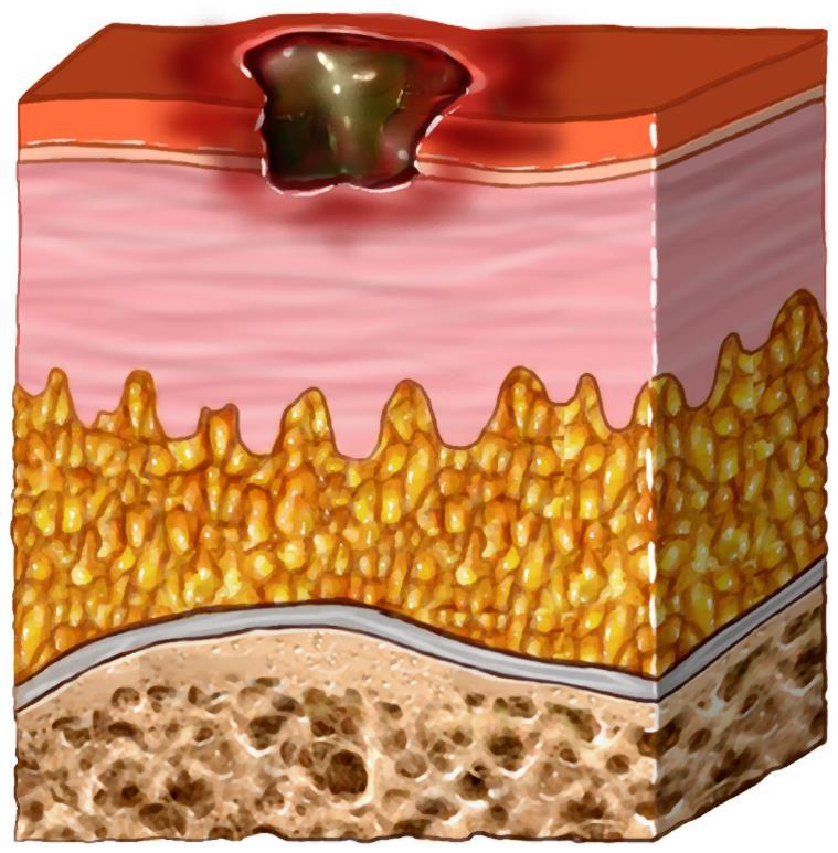 Pressure injury - Stage 2 4 Partial thickness loss of skin involving epidermis and/or dermis Presents as a intact or open serum
