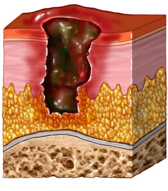 Pressure injury - Stage 3 4 Full thickness tissue loss involving damage to or necrosis of subcutaneous tissue May extend down to, but not through, underlying fascia