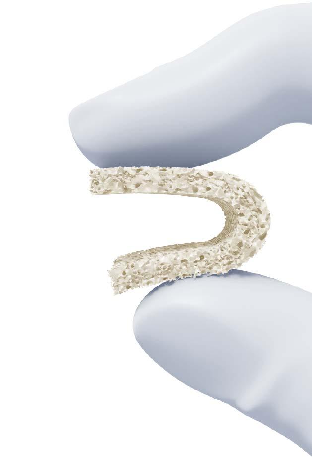 CONFORM Flex CONFORM flex is: Osteoinductive 2,3 A unique demineralization process is used to expose the natural bone morphogenic proteins (BMPs), while maintaining a cell-friendly environment.