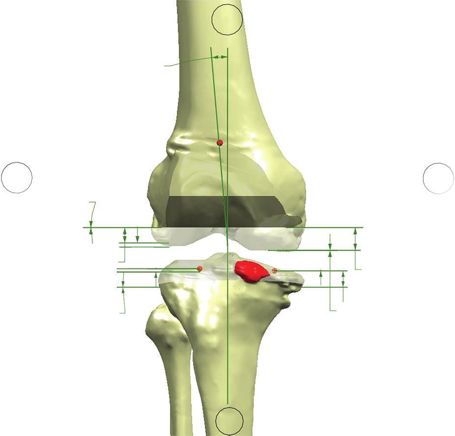 Advances in Orthopedics 3 Table 1: Mean absolute difference between the planned (CPI) and ideal (traditional TKA) placement of the femoral and tibial components.