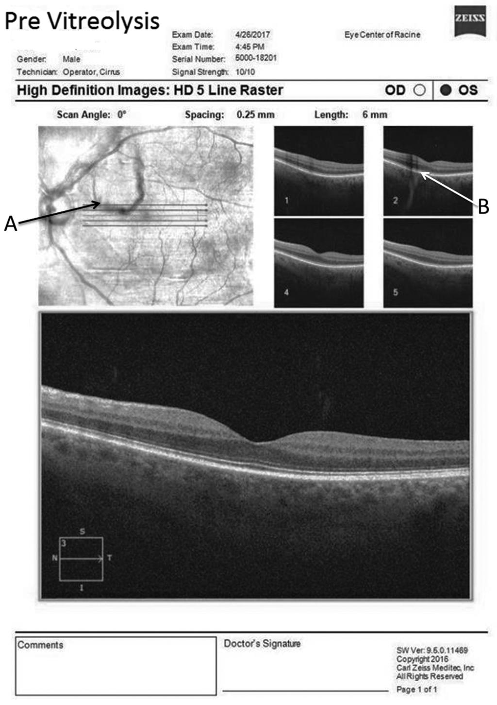 Figure 1. Pre-vitreolysis, patient reported distortion and shadow in central vision. (A) Floater over the macula. (B) Shadow cast from the floater.