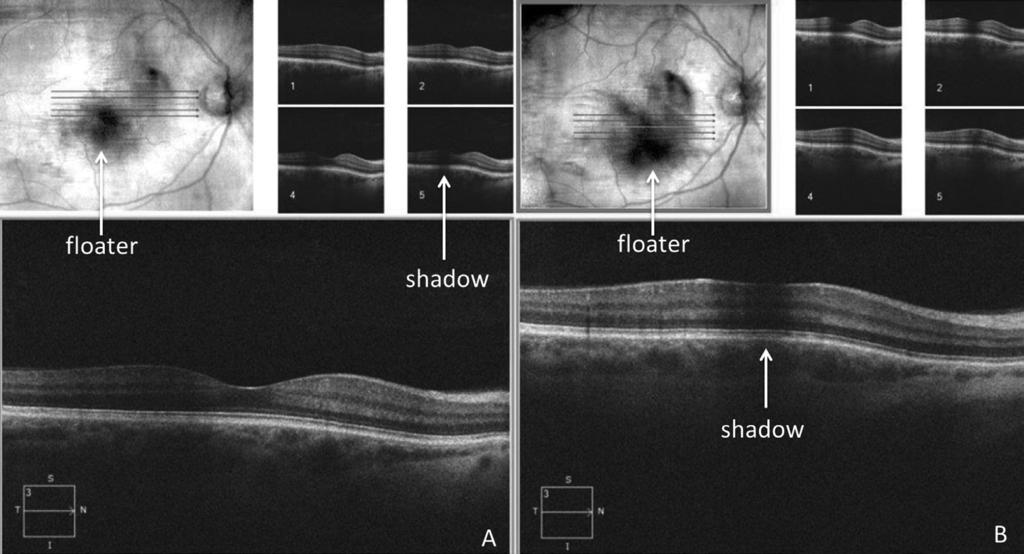 Figure 3. Pre-laser floater removal optical coherence tomography (OCT) on two separate days. (A) Preoperative OCT taken on June 5 and (B) preoperative OCT taken on June 13.