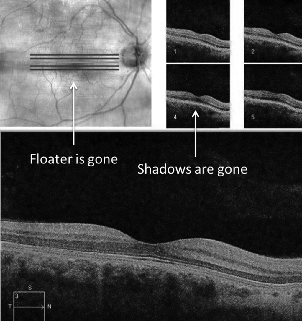 Figure 4. Post- laser floater removal optical coherence tomography 30 minutes after the procedure.