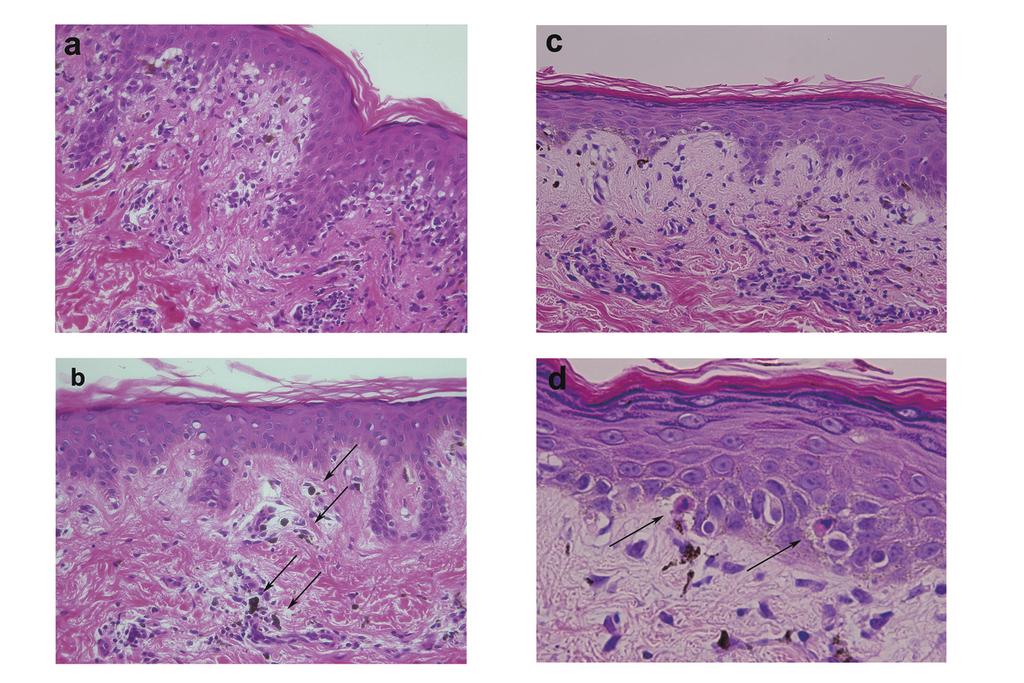 Figure 2 Histopathology Case 1: (a) A red maculopapule shows vacuolar changes in the basal layer and perivascular infiltration of lymphocytes.
