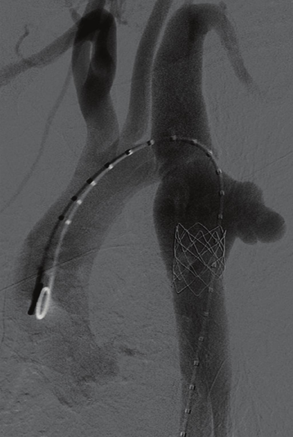 2 Figure 1: Aortic angiography showing an angulated aortic arch and a small caliber thoracic aorta.