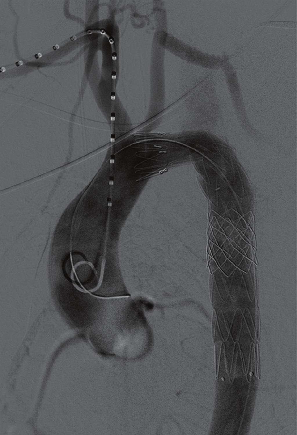 Final result after completion of the carotid subclavian bypass and exclusion of the pseudoaneurysm. A heparin-related leak can be found which extends to the left subclavian artery.