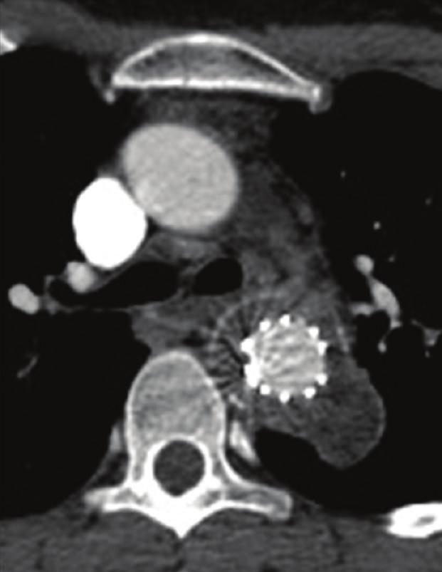 No complication was found in the angio-ct (Figures 1 and 1). After 3 