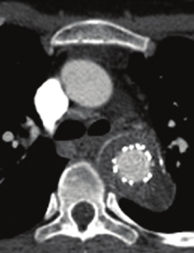 Case 2 A 46-years-old male patient, who presented with mild hemoptysis at our institution, was operated at the age of 17 years for aortic coarctation using a prosthetic patch.