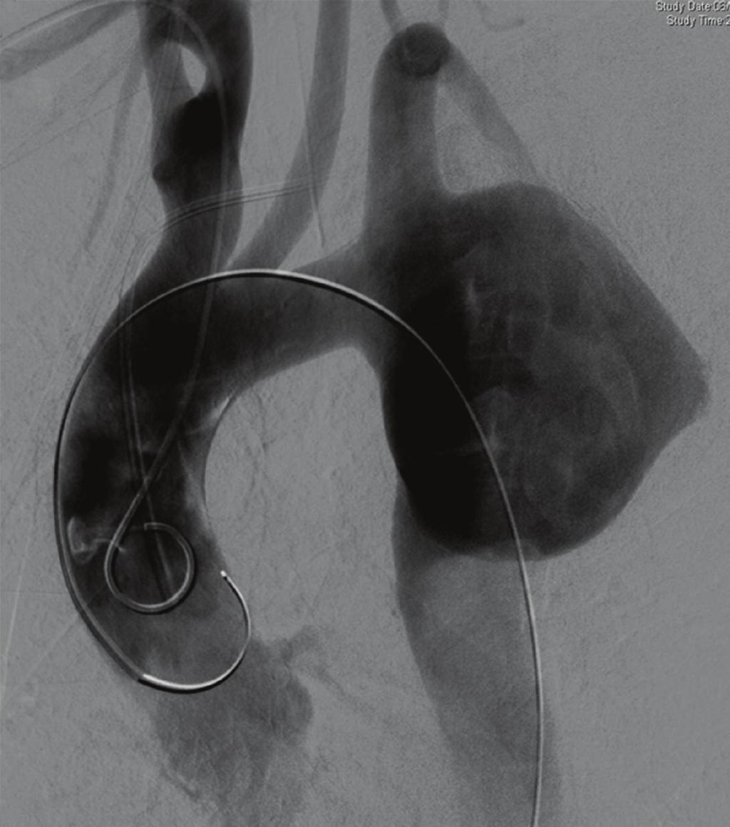 3 Figure 2: Angiography shows a large aortic pseudoaneurysm extending to the origin of the left subclavian artery with an