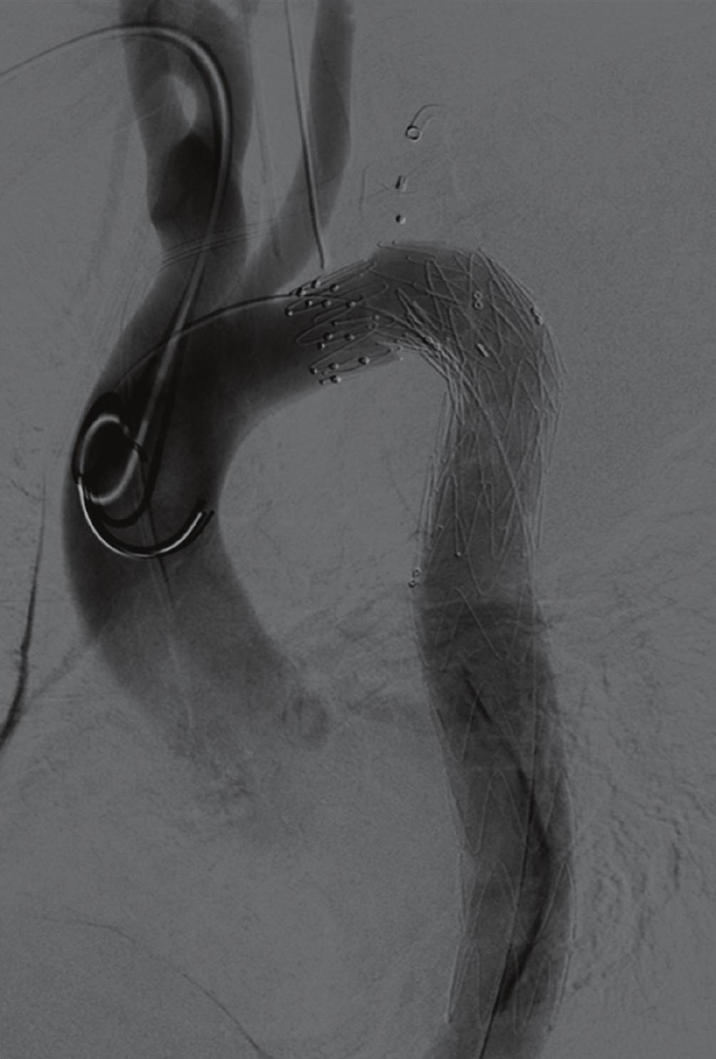 Final angiography after stent placement and embolization of the left subclavian artery demonstrates complete exclusion of the