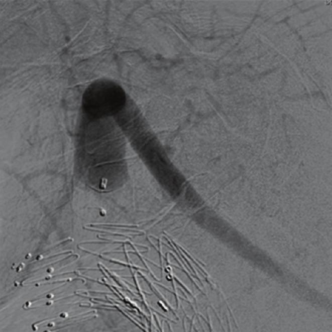 and Late angiographic image shows left subclavian artery perfusion due to subclavian steal.