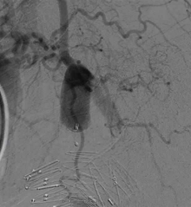Selective intraaneurismal angiography was performed with a 1.9 Fr microcatheter showing a long neck.
