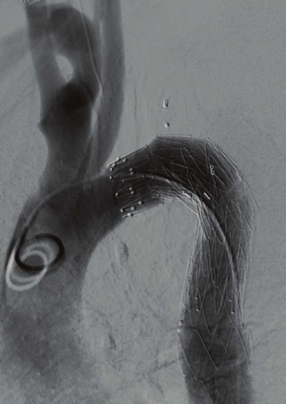 Selective angiography using a 5 Fr Sidewinder catheter shows a type I leak which can also be found on the angio-ct.