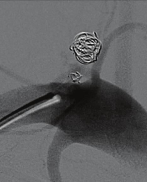 In the last decade, endovascular techniques were introduced for the treatment of late complications after coarctation surgery in