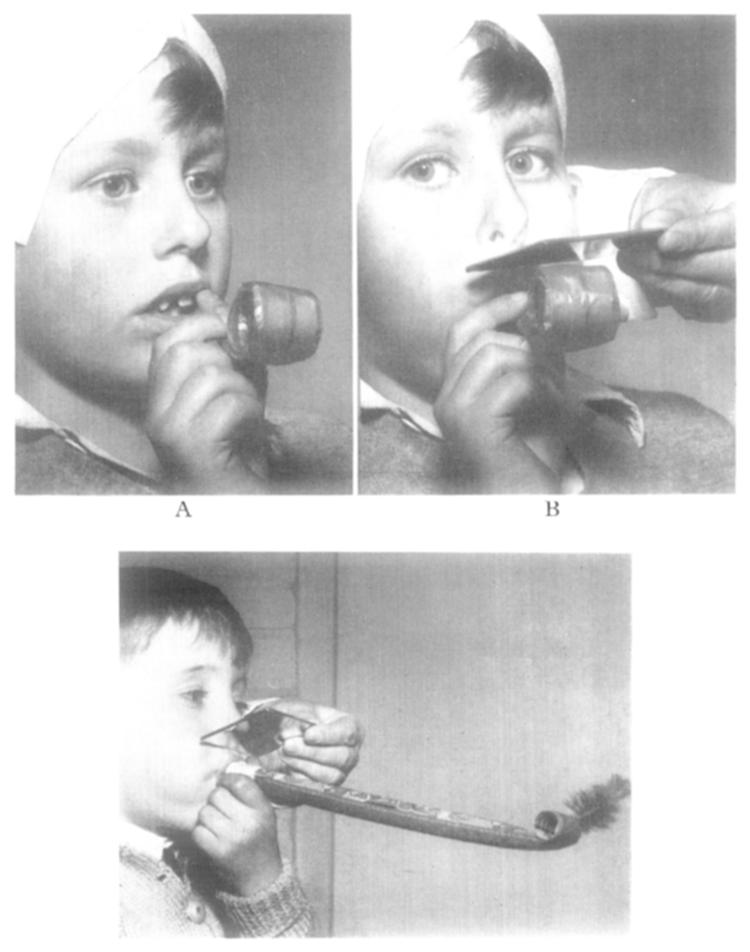 I The carnival blower test. A, The carnival blower held by the patient ready to be inserted between the lips. B, A negative test.