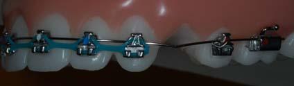 Real C-Chain or Power Chain Allows you to prescribe how the upper incisors should be leveled.