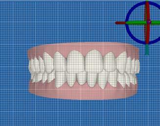 tight and virtual c-chain aligners continue to be dispensed, there is a high