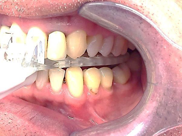 Taking a protrusive bite record Cont'd... Inadequate coverage of last tooth by fork for a distal wrap case.