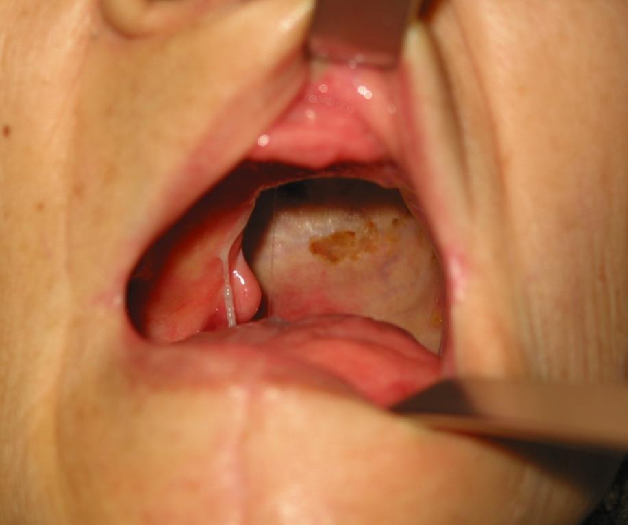 Complications are common Fee s series of 37 cases had complication rate of 54% In King s series, the following complications were noted Soft palate dysfunction (54.8%) Trismus (48.4%) Dysphagia (38.