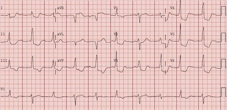 ECG with RBBB