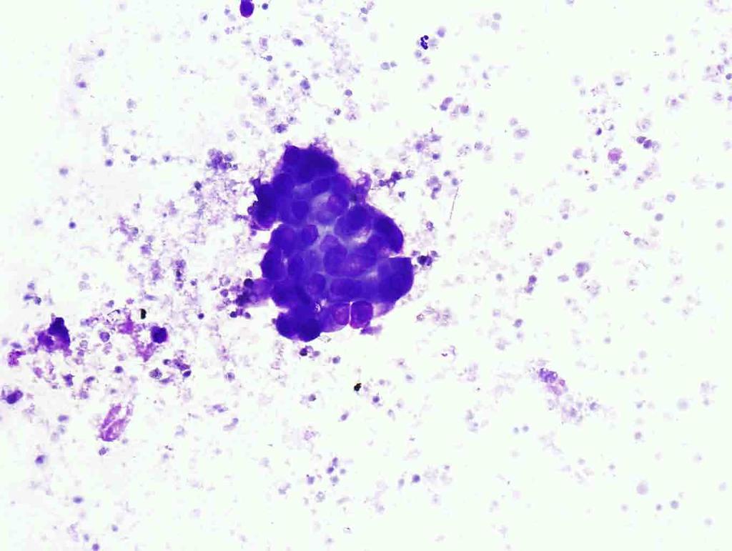 Pancreas, endoscopic ultrasound-guided FNA: Diff-Quik stain, 20x Presentation material