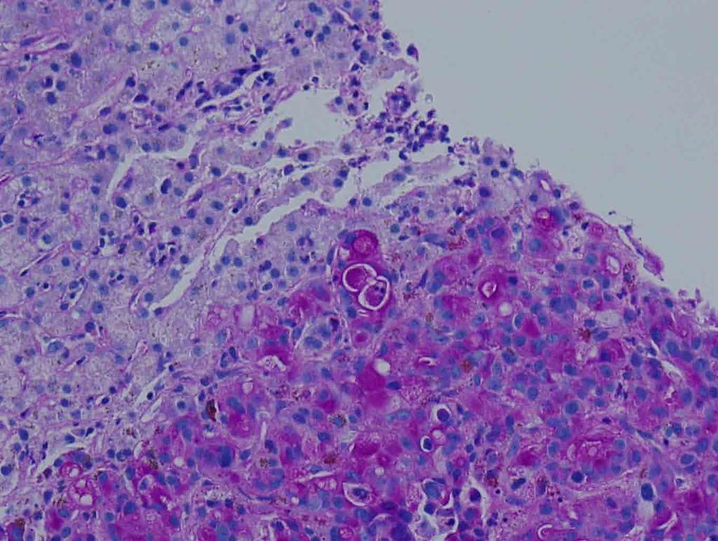 Liver, right lobe, biopsy: PASD stain, 20x Presentation material is for