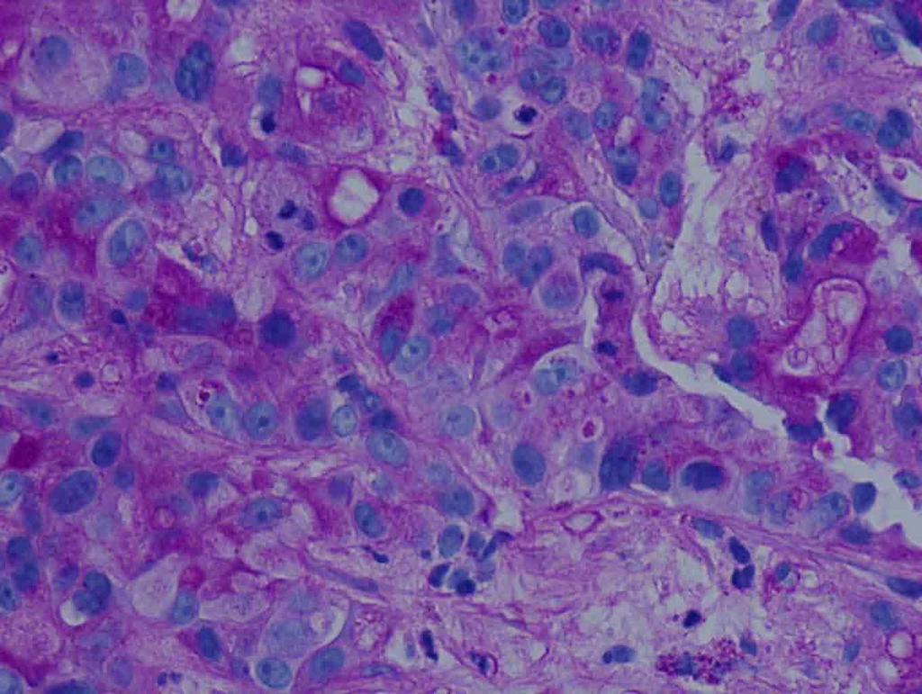 Liver, right lobe, biopsy: PASD stain, 40x Presentation material is for