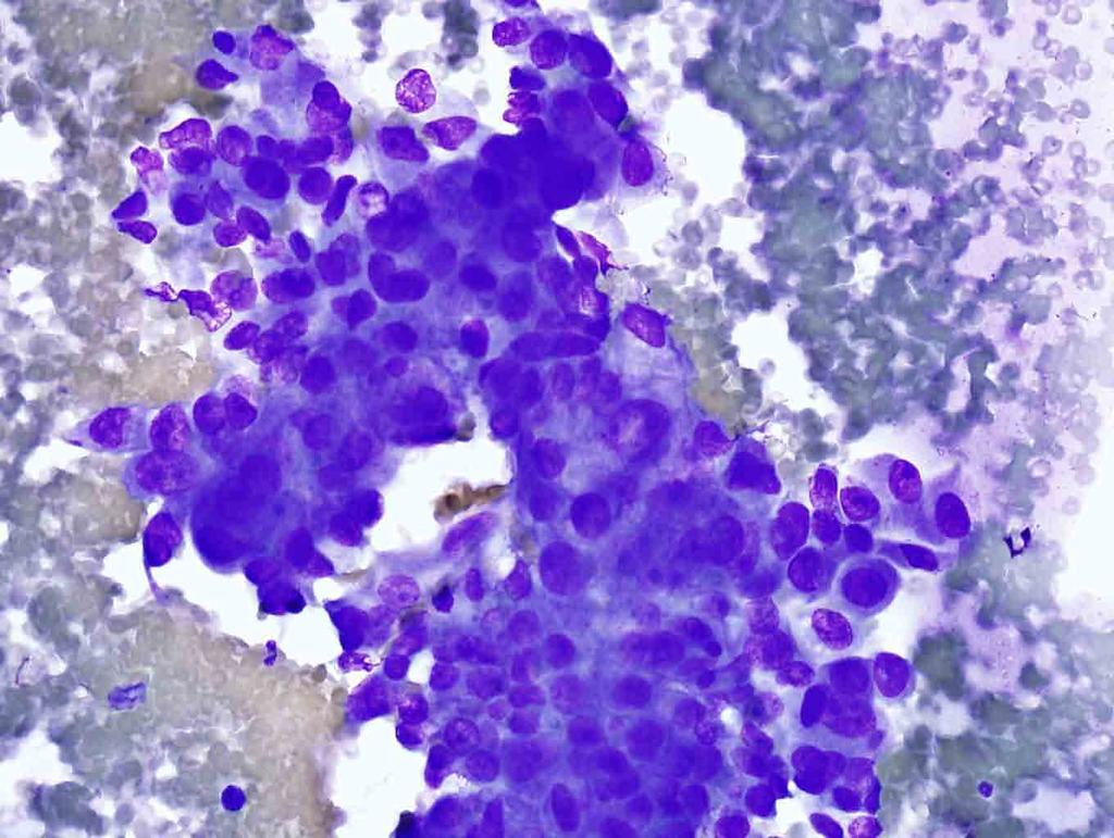 Rib, left, 6 th, CT-guided FNA: Diff-Quik stain, 20x Presentation material is