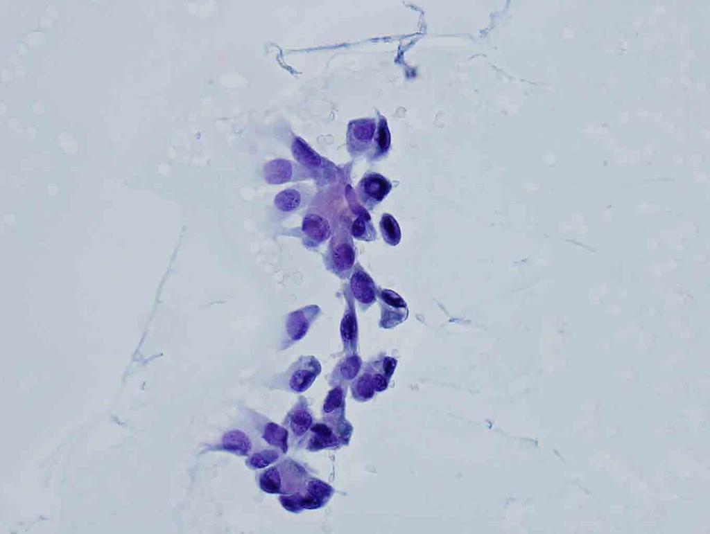 Rib, left, 6 th, CT-guided FNA: Papanicolaou stain, 20x Presentation material is